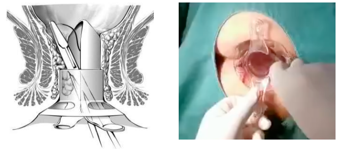 痔疮吻合器怎么使用实践技巧 ｜吻合器使用过程中常见问题及解决办法（四）_https://www.jmylbn.com_新闻资讯_第3张