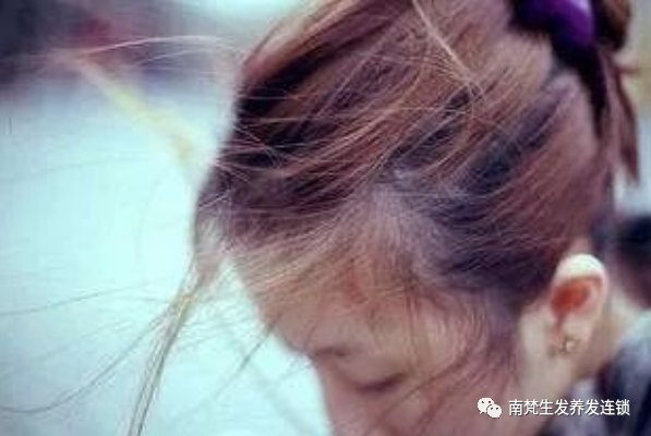 脱发的10大原因，你知道多少?