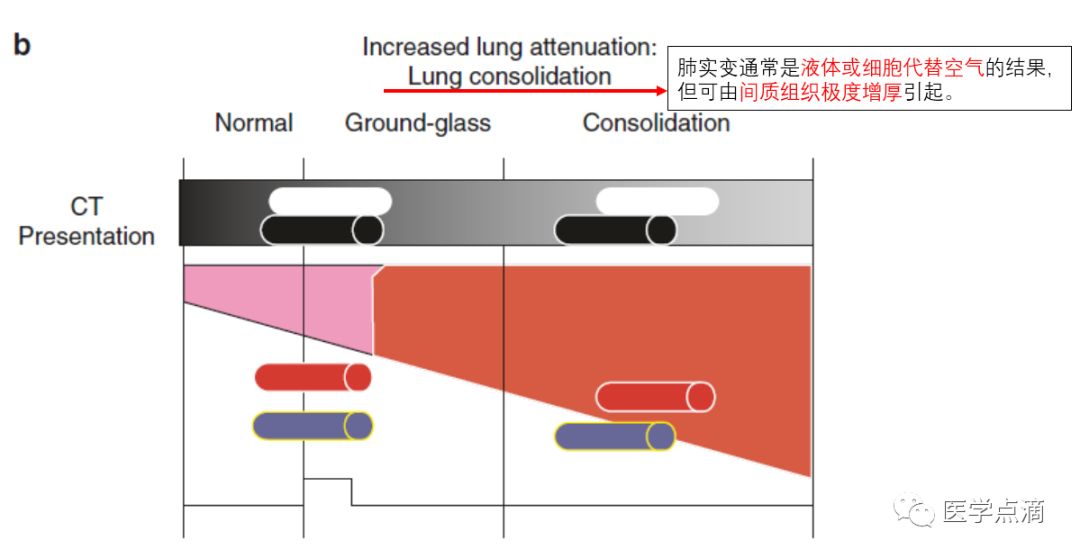 胸部ct那些事儿之肺密度增高 磨玻璃影 医学点滴 微信公众号文章阅读 Wemp