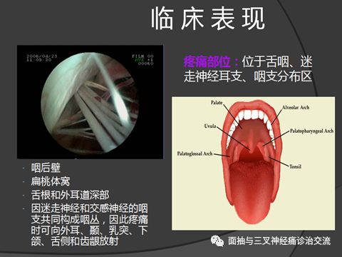 诊前须知 舌根痛 嗓子痛 耳深处疼痛可能是舌咽神经痛 面抽与三叉神经痛诊治交流 微信公众号文章阅读 Wemp
