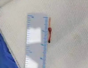 留置针怎么取出长达5年！男孩体内遗留留置针软管，如今…_https://www.jmylbn.com_新闻资讯_第1张