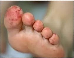 华法林之旅——华法林的不良反应有哪些？