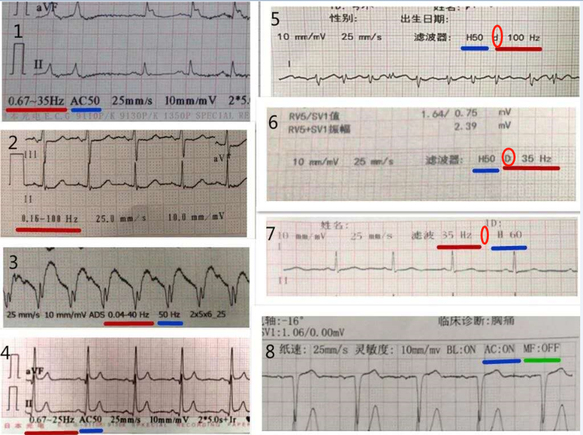 心电图纸怎么看心电图记录纸上的小秘密｜临床解惑_https://www.jmylbn.com_新闻资讯_第2张