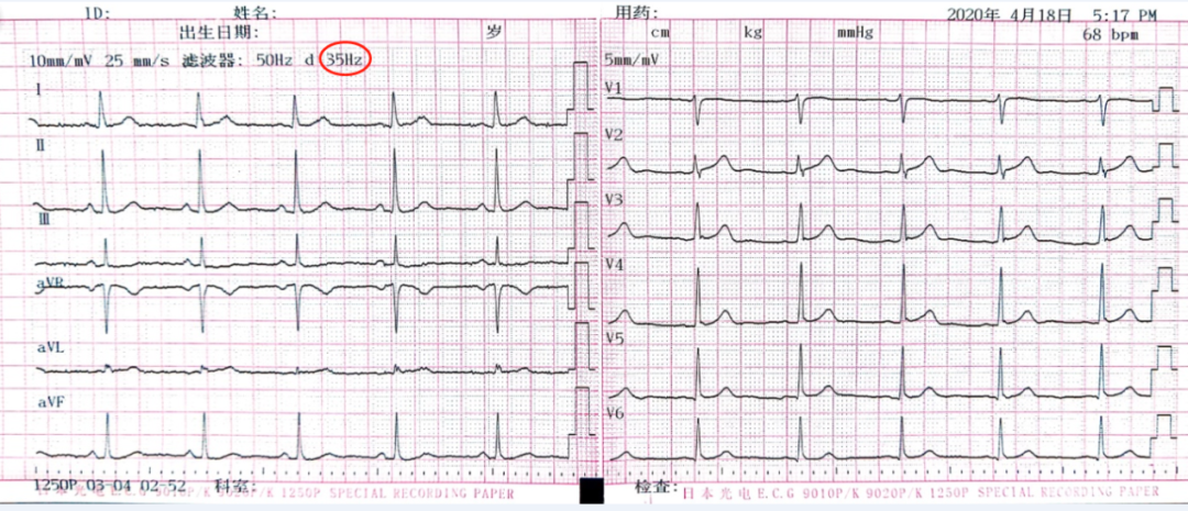 心电图纸怎么看心电图记录纸上的小秘密｜临床解惑_https://www.jmylbn.com_新闻资讯_第8张