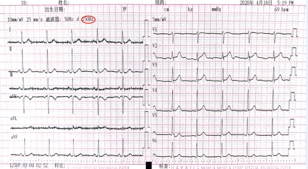 心电图纸怎么看心电图记录纸上的小秘密｜临床解惑_https://www.jmylbn.com_新闻资讯_第9张
