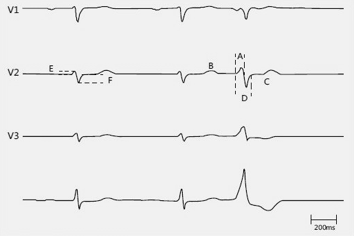心电图怎么6道流出道室早／室速体表心电图的特点、定位及鉴别_https://www.jmylbn.com_新闻资讯_第4张