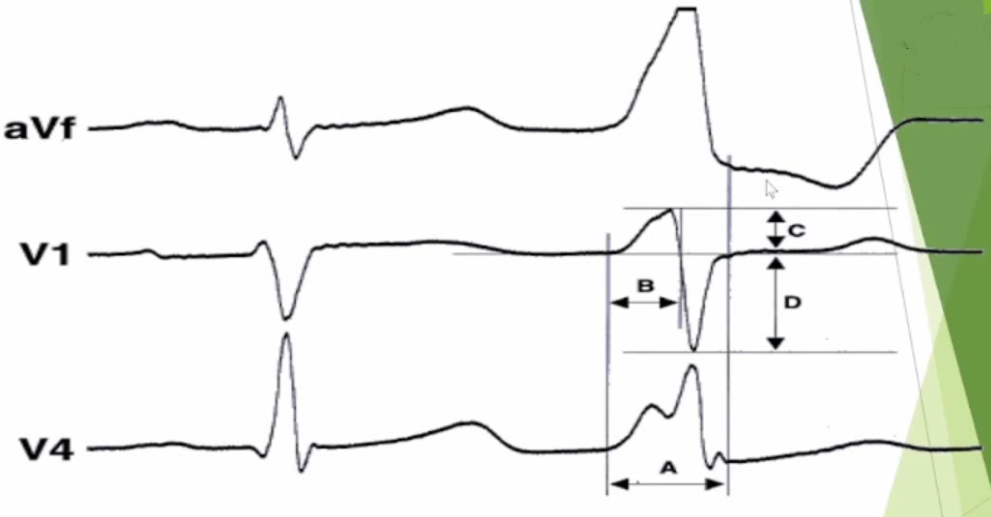 心电图怎么6道流出道室早／室速体表心电图的特点、定位及鉴别_https://www.jmylbn.com_新闻资讯_第2张
