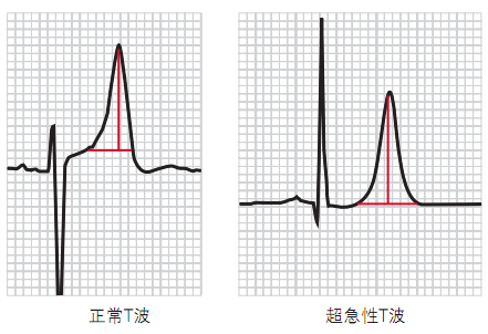 12导为什么是标准导联10分钟掌握标准心电图的基础知识_https://www.jmylbn.com_新闻资讯_第10张