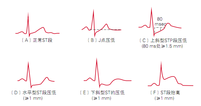 12导为什么是标准导联10分钟掌握标准心电图的基础知识_https://www.jmylbn.com_新闻资讯_第9张