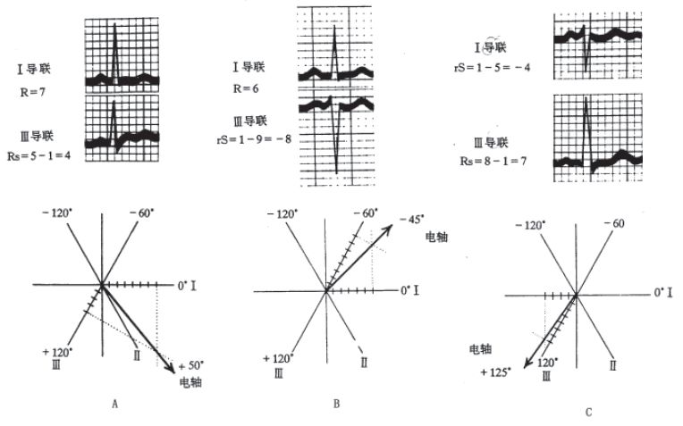 什么是同步心电图心电轴的测量方法，你掌握了几种？_https://www.jmylbn.com_新闻资讯_第8张