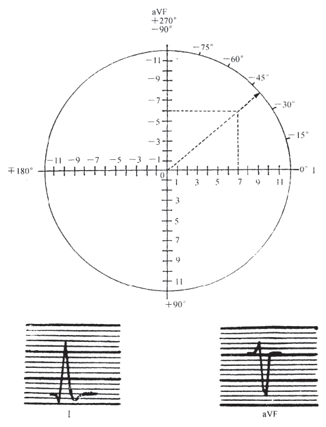 什么是同步心电图心电轴的测量方法，你掌握了几种？_https://www.jmylbn.com_新闻资讯_第12张