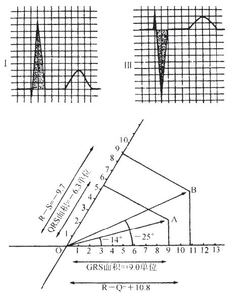 什么是同步心电图心电轴的测量方法，你掌握了几种？_https://www.jmylbn.com_新闻资讯_第9张