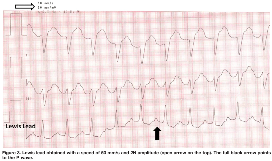 心电监护怎么看图心电图有问题？别急，先看看导联位置放对了吗_https://www.jmylbn.com_新闻资讯_第12张