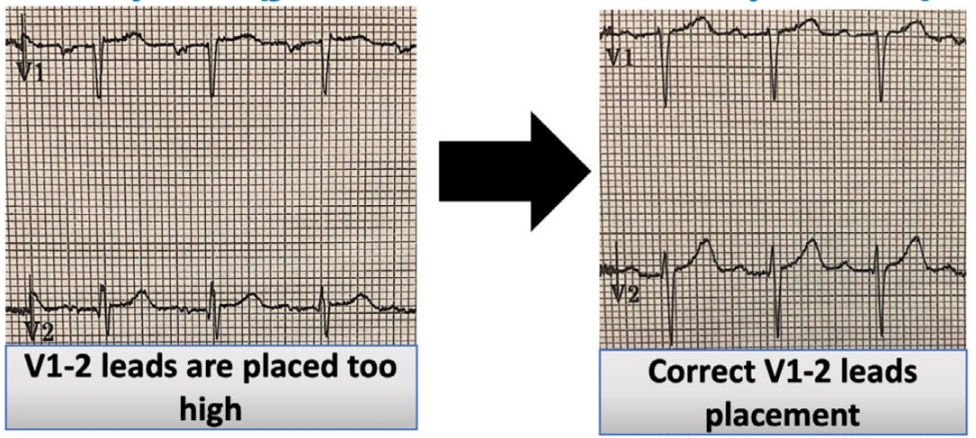 心电监护怎么看图心电图有问题？别急，先看看导联位置放对了吗_https://www.jmylbn.com_新闻资讯_第7张