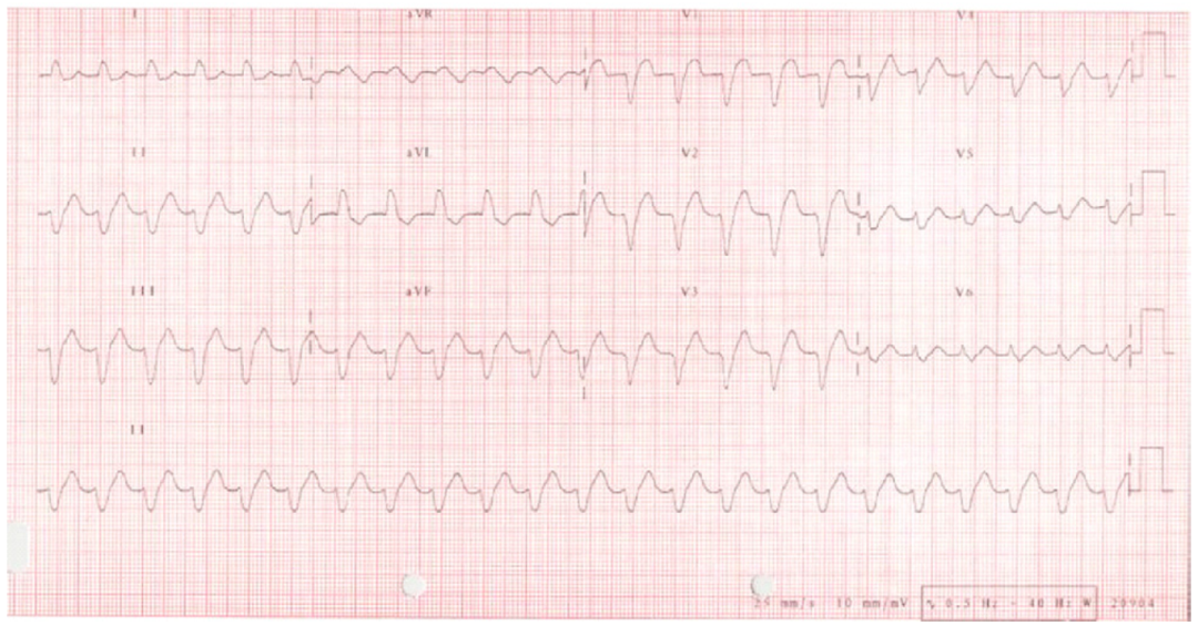心电监护怎么看图心电图有问题？别急，先看看导联位置放对了吗_https://www.jmylbn.com_新闻资讯_第11张