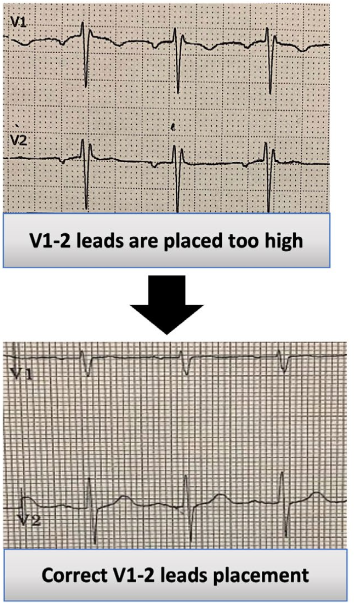 心电监护怎么看图心电图有问题？别急，先看看导联位置放对了吗_https://www.jmylbn.com_新闻资讯_第8张