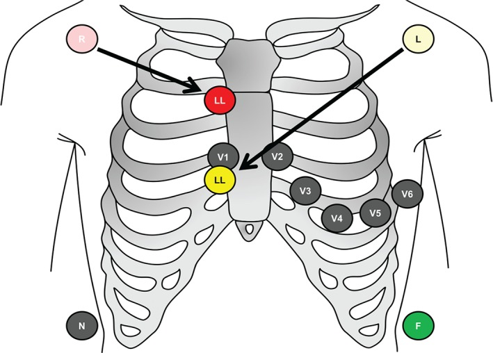 心电监护怎么看图心电图有问题？别急，先看看导联位置放对了吗_https://www.jmylbn.com_新闻资讯_第10张