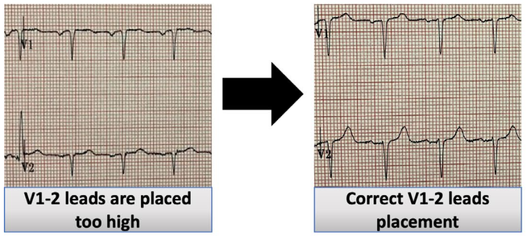心电监护怎么看图心电图有问题？别急，先看看导联位置放对了吗_https://www.jmylbn.com_新闻资讯_第6张