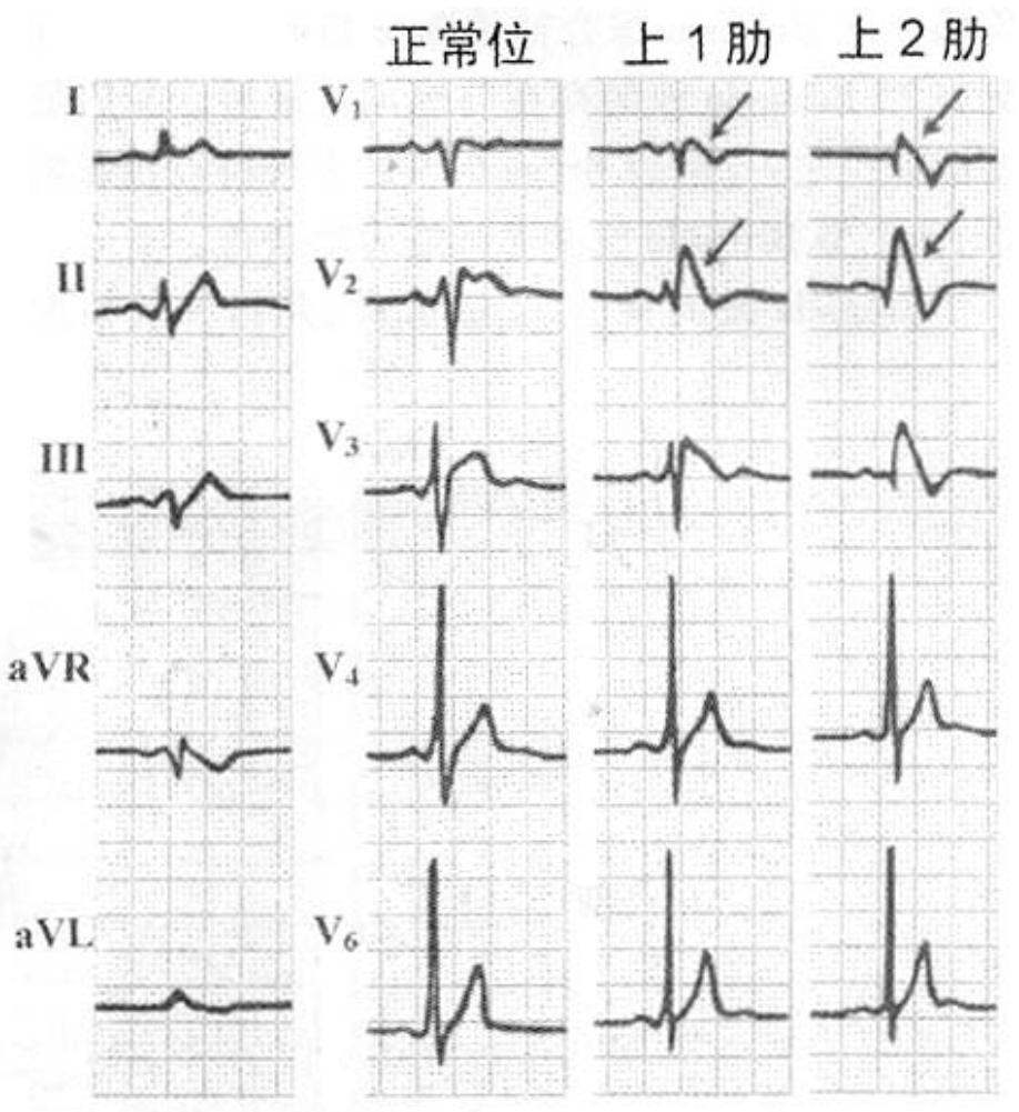 心电监护怎么看图心电图有问题？别急，先看看导联位置放对了吗_https://www.jmylbn.com_新闻资讯_第9张