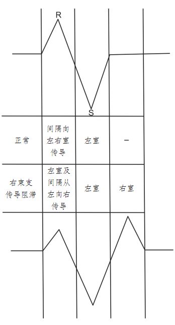 左 右束支传导阻滞详解 朱晓晓心电资讯 微信公众号文章阅读 Wemp