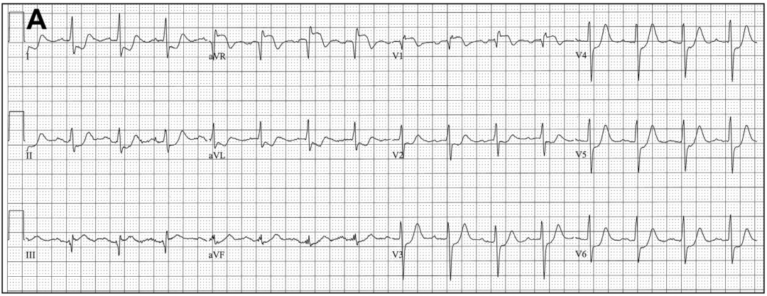 心电图怎么切换导联颠覆传统，巧看心电图：V1、V2、V3导联不仅仅是胸前导联_https://www.jmylbn.com_新闻资讯_第6张