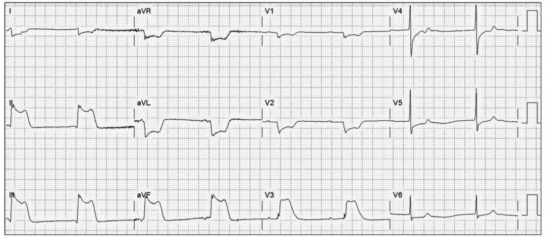 心电图怎么切换导联颠覆传统，巧看心电图：V1、V2、V3导联不仅仅是胸前导联_https://www.jmylbn.com_新闻资讯_第8张