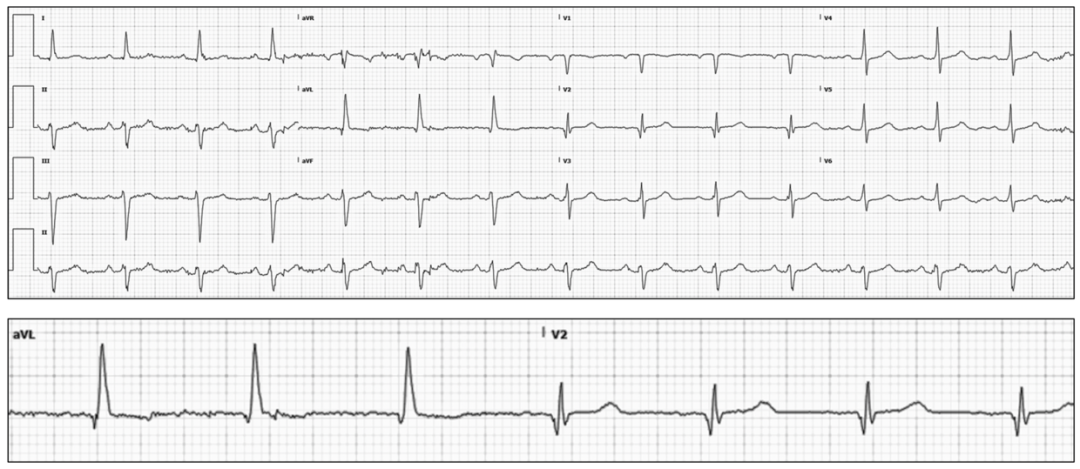 心电图怎么切换导联颠覆传统，巧看心电图：V1、V2、V3导联不仅仅是胸前导联_https://www.jmylbn.com_新闻资讯_第7张