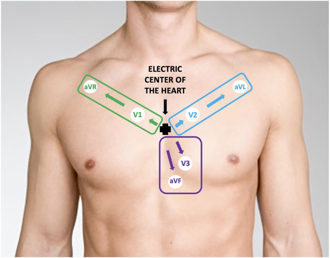 心电图怎么切换导联颠覆传统，巧看心电图：V1、V2、V3导联不仅仅是胸前导联_https://www.jmylbn.com_新闻资讯_第5张