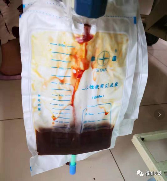 引流管怎么冲管居家护理：引流管看护和简单冲管_https://www.jmylbn.com_新闻资讯_第7张