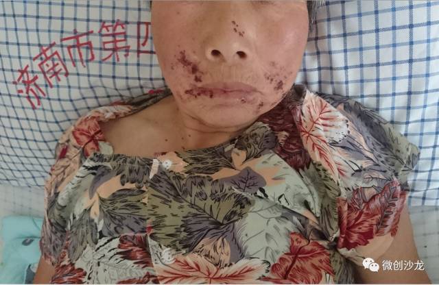 引流管怎么冲管居家护理：引流管看护和简单冲管_https://www.jmylbn.com_新闻资讯_第6张