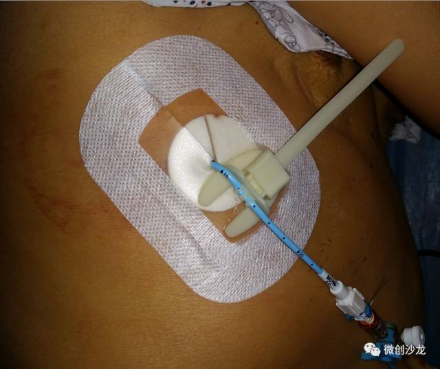引流管怎么冲管居家护理：引流管看护和简单冲管_https://www.jmylbn.com_新闻资讯_第8张
