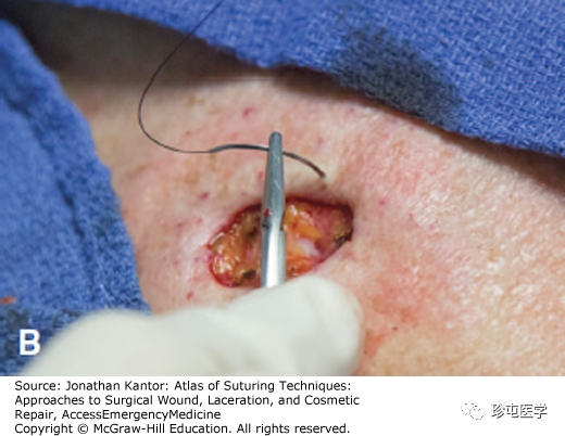 医用缝合包怎么包荷包缝合_https://www.jmylbn.com_新闻资讯_第2张