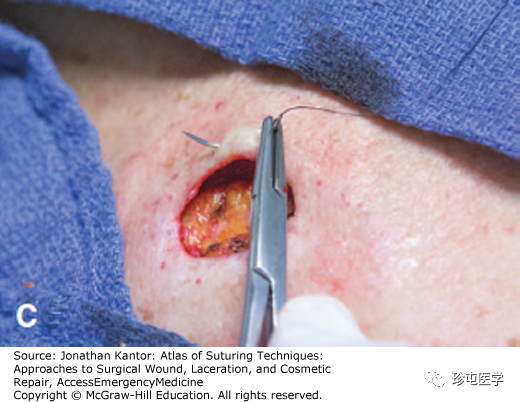 医用缝合包怎么包荷包缝合_https://www.jmylbn.com_新闻资讯_第3张