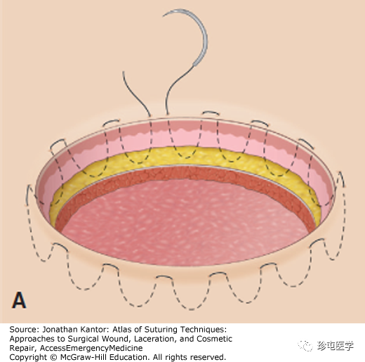 医用缝合包怎么包荷包缝合_https://www.jmylbn.com_新闻资讯_第1张