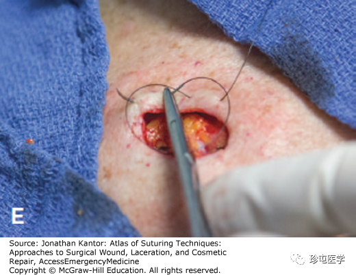 医用缝合包怎么包荷包缝合_https://www.jmylbn.com_新闻资讯_第5张