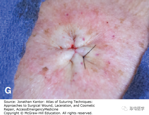 医用缝合包怎么包荷包缝合_https://www.jmylbn.com_新闻资讯_第7张