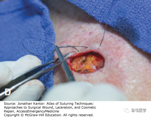 医用缝合包怎么包荷包缝合_https://www.jmylbn.com_新闻资讯_第4张