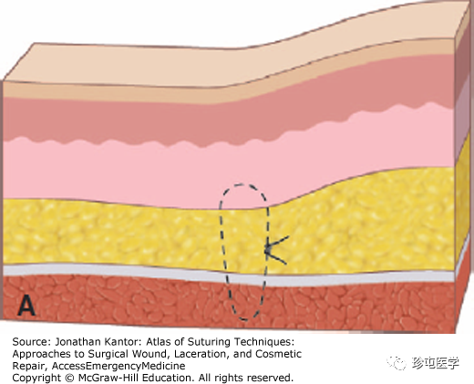 慕什么缝线悬挂式缝合_https://www.jmylbn.com_新闻资讯_第1张