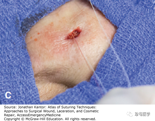 慕什么缝线悬挂式缝合_https://www.jmylbn.com_新闻资讯_第3张