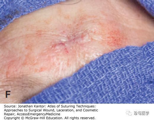 慕什么缝线悬挂式缝合_https://www.jmylbn.com_新闻资讯_第6张