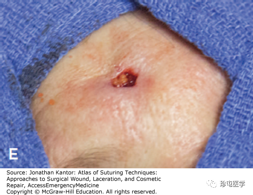 慕什么缝线悬挂式缝合_https://www.jmylbn.com_新闻资讯_第5张