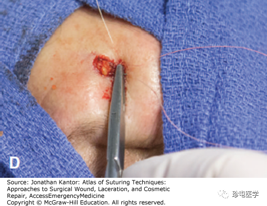 慕什么缝线悬挂式缝合_https://www.jmylbn.com_新闻资讯_第4张