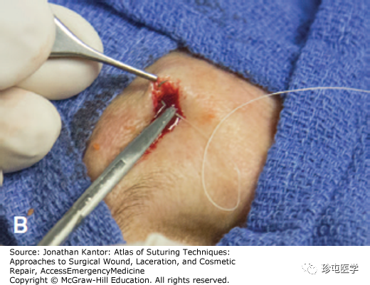 慕什么缝线悬挂式缝合_https://www.jmylbn.com_新闻资讯_第2张