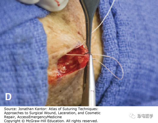缝线怎么打结打结缝合_https://www.jmylbn.com_新闻资讯_第4张