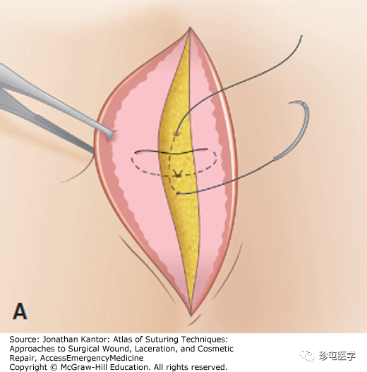 缝线怎么打结打结缝合_https://www.jmylbn.com_新闻资讯_第1张