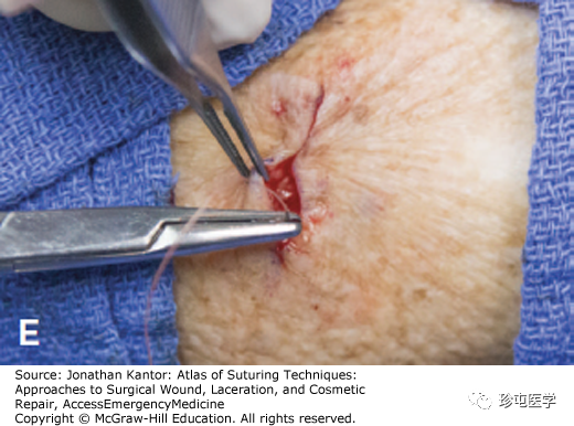 缝线怎么打结打结缝合_https://www.jmylbn.com_新闻资讯_第5张