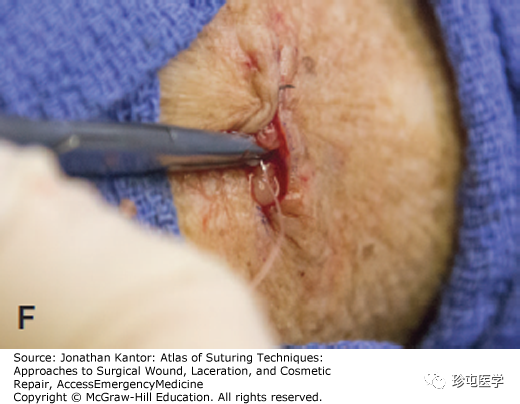 缝线怎么打结打结缝合_https://www.jmylbn.com_新闻资讯_第6张