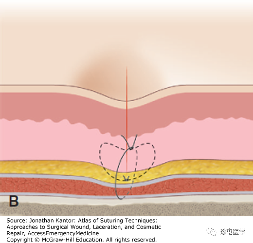 缝线怎么打结打结缝合_https://www.jmylbn.com_新闻资讯_第2张