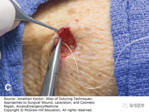 缝线怎么打结打结缝合_https://www.jmylbn.com_新闻资讯_第3张