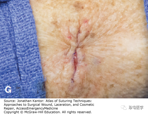缝线怎么打结打结缝合_https://www.jmylbn.com_新闻资讯_第7张
